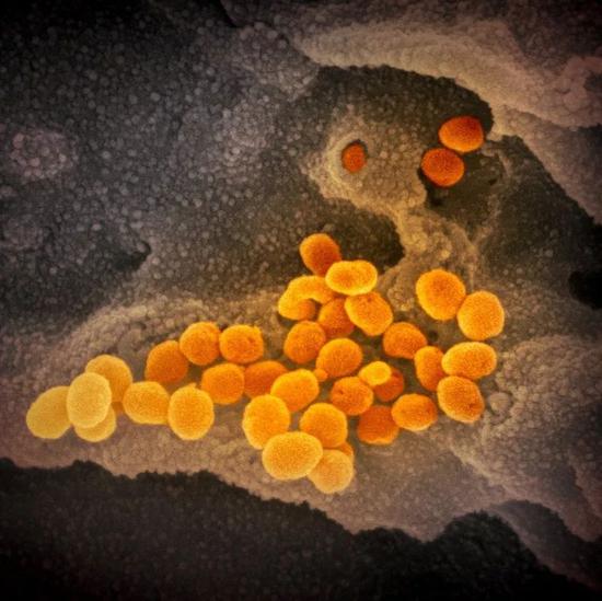  扫描显微镜图像：橙色的部分就是引发新冠肺炎的冠状病毒。/NIAID-RML